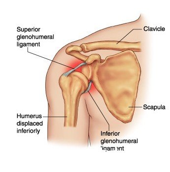 为何肩关节损伤会惹上肩周炎