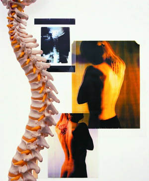 强直性脊柱炎应该怎么去进行治疗 强直性脊柱炎应该怎么去进行治疗