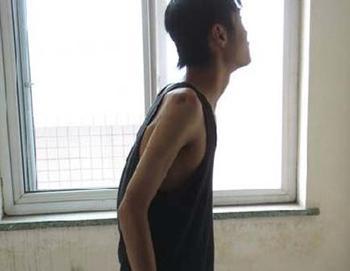 郑州哪里治强直性脊柱炎最好 郑州哪里治强直性脊柱炎最好