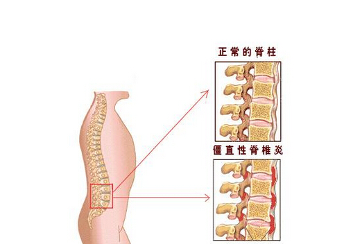 得了强直有什么好的保养的方法 得了强直有什么好的保养的方法