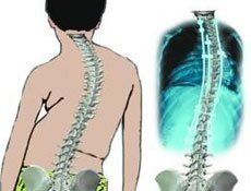 强直性脊柱炎在治疗的时候要注意什么? 强直性脊柱炎在治疗的时候要注意什么?