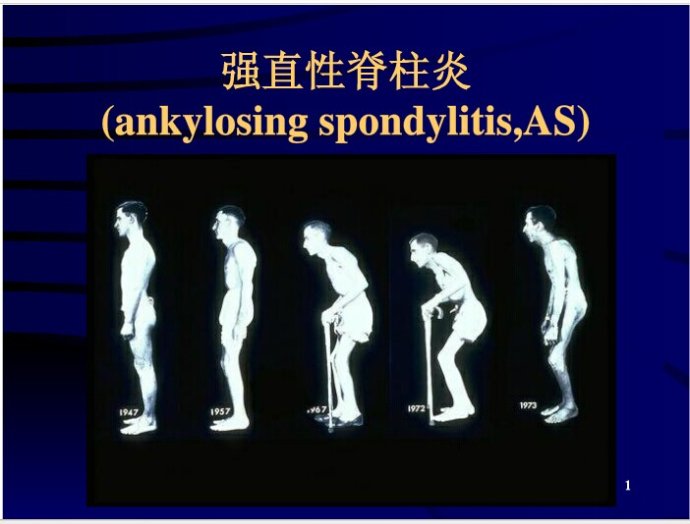 郑州强直性脊椎炎医院那家好 郑州强直性脊椎炎医院那家好