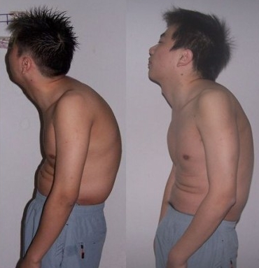 强直性脊柱炎怎么通过中医来治疗 强直性脊柱炎怎么通过中医来治疗