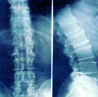 强直会不会有背部疼痛的情况? 强直会不会有背部疼痛的情况?