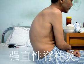 郑州强直性脊柱炎医院哪家好 郑州强直性脊柱炎医院哪家好