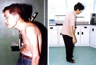 你知道强直性脊柱炎会有哪些表现吗 你知道强直性脊柱炎会有哪些表现吗