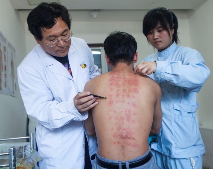 预防强直性脊柱炎四点要做到 预防强直性脊柱炎四点要做到