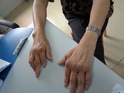 经过治疗后,患者手部痛风石已经消失,体内尿酸也降为正常值 经过治疗后,患者手部痛风石已经消失,体内尿酸也降为正常值