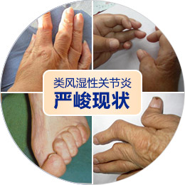 关注520“全国助残日”,别让风湿免疫病成为“致残杀手”! 关注520“全国助残日”,别让风湿免疫病成为“致残杀手”!