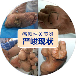 关注520“全国助残日”,别让风湿免疫病成为“致残杀手”! 关注520“全国助残日”,别让风湿免疫病成为“致残杀手”!