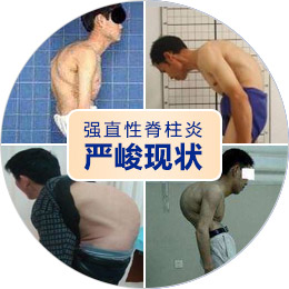 关注520“全国助残日”,别让风湿免疫病成为“致残杀手”! 关注520“全国助残日”,别让风湿免疫病成为“致残杀手”!