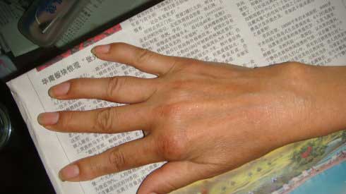治疗后患者右手情况 类风湿性关节炎患者五年艰辛求医路