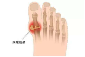 碱性食物缓解痛风 碱性食物能够缓解痛风症状!