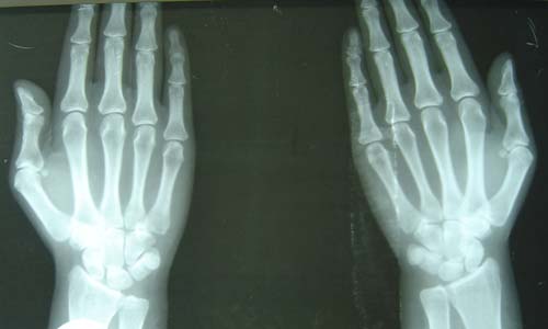 X光显示患者双手骨质恢复正常,关节面光整) 5年类风湿的她心焦寻医盼 ,终在我院得偿所愿