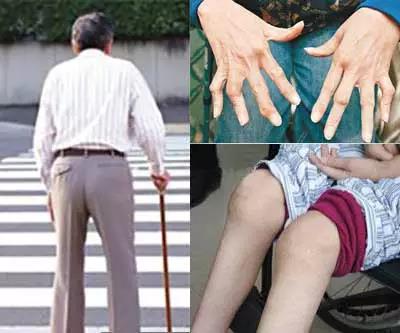 ,握正确艾灸方法改善风湿! 艾灸治疗风湿效果,握正确艾灸方法改善风湿!