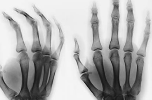 类风湿老患友这几点要记牢 类风湿老患友这几点要记牢