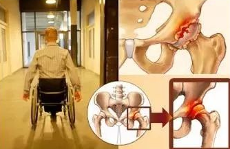 河南主治股骨头坏死医院.jpg 河南主治股骨头坏死医院