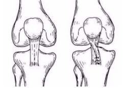 类风湿患者可以通过哪些手术治疗? 类风湿患者可以通过哪些手术治疗?